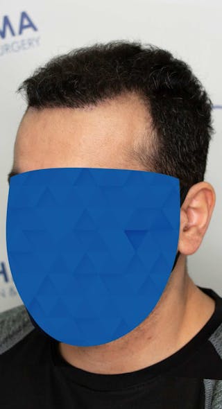 Results Before & After Gallery - Patient 369381 - Image 4