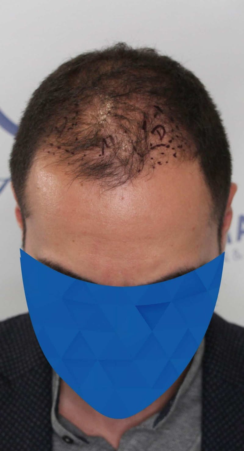 Results Before & After Gallery - Patient 336185 - Image 1