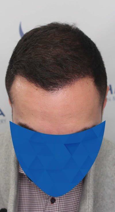 Results Before & After Gallery - Patient 336185 - Image 2