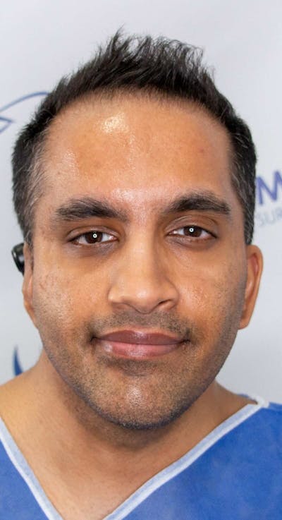 Results Before & After Gallery - Patient 175621 - Image 1