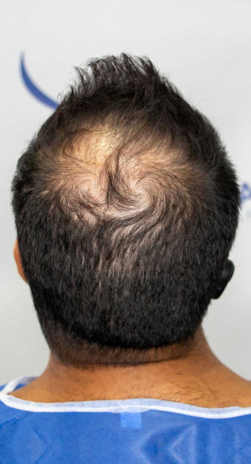 Results Before & After Gallery - Patient 175621 - Image 3