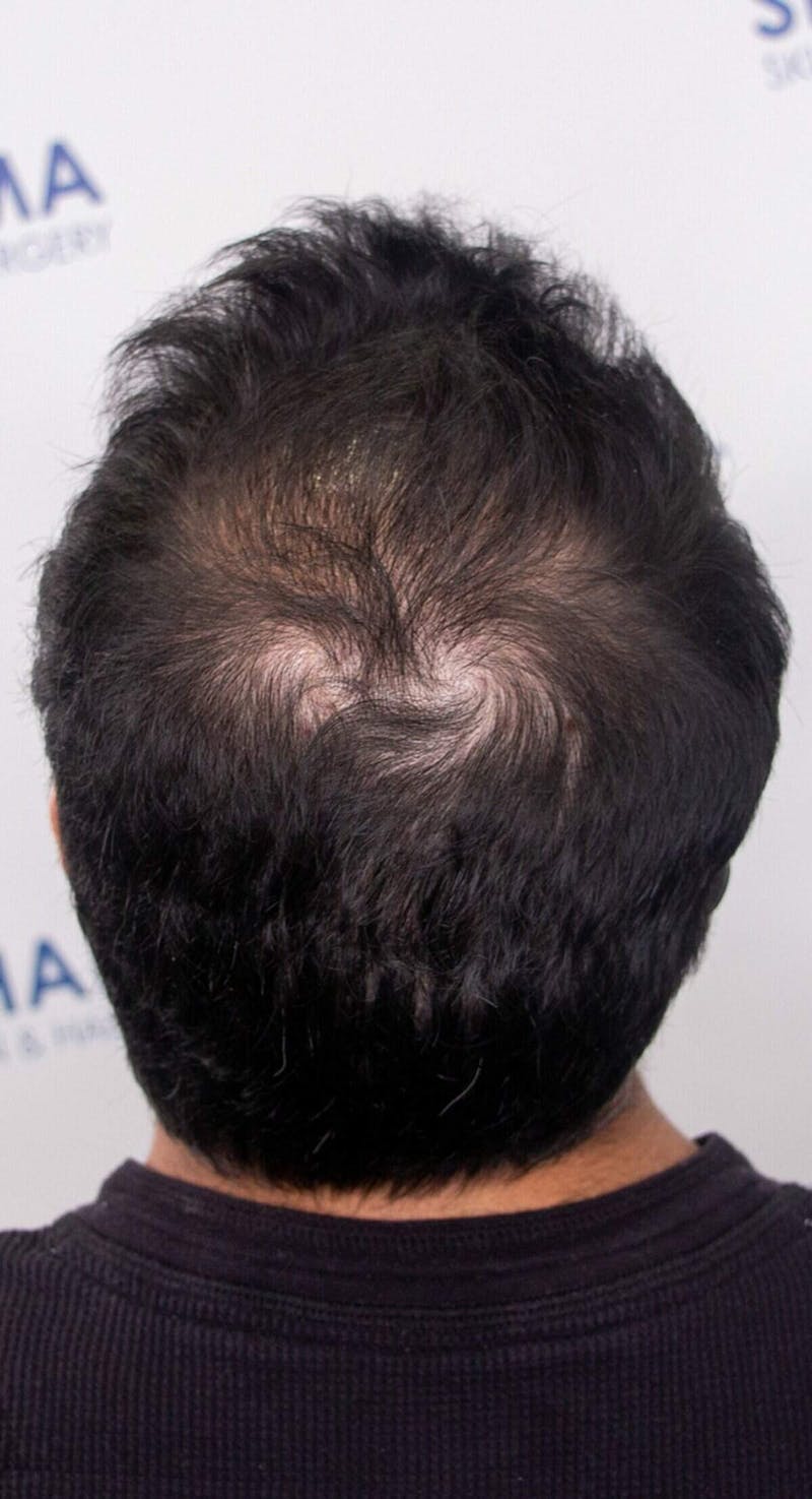 Results Before & After Gallery - Patient 175621 - Image 4