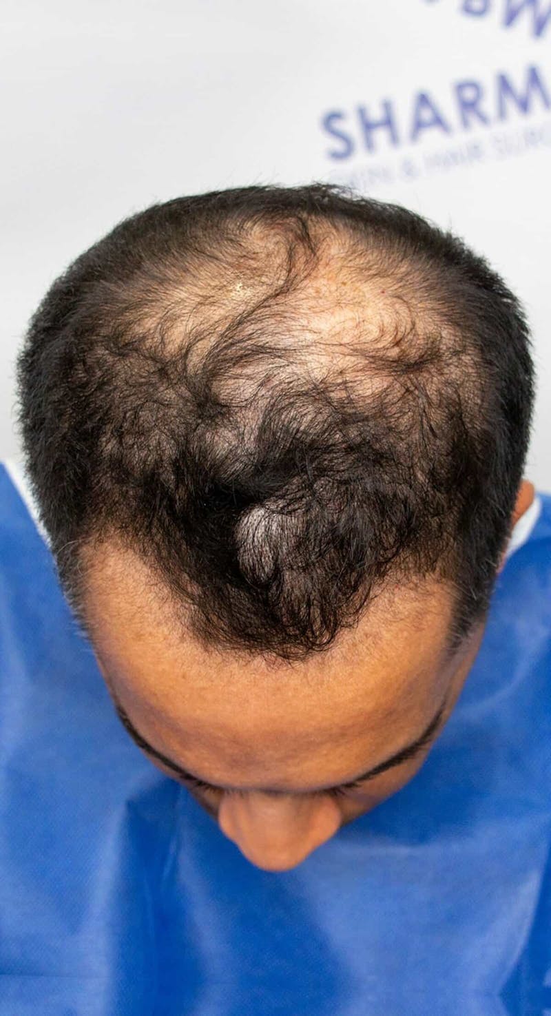 Results Before & After Gallery - Patient 175621 - Image 5