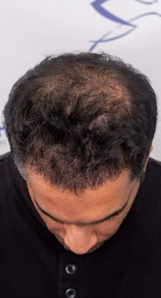 Results Before & After Gallery - Patient 175621 - Image 6