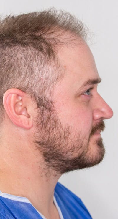 Results Before & After Gallery - Patient 342820 - Image 1