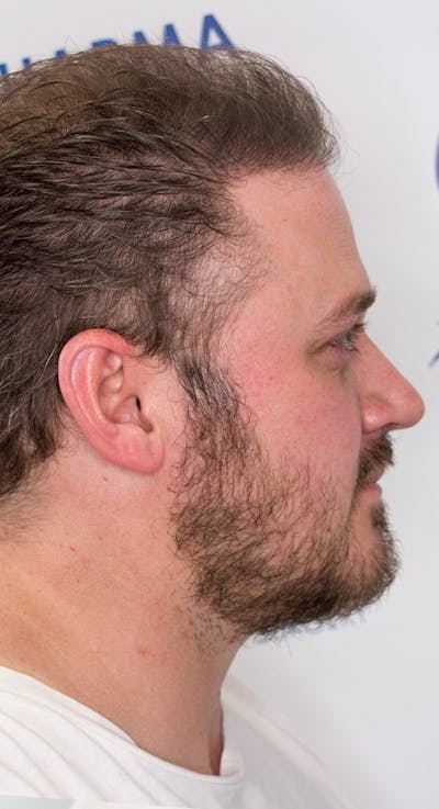 Results Before & After Gallery - Patient 342820 - Image 2