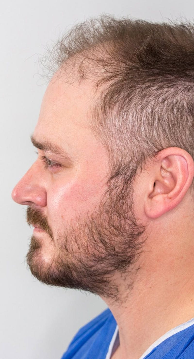 Results Before & After Gallery - Patient 342820 - Image 3