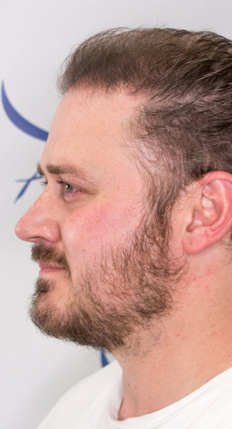 Results Before & After Gallery - Patient 342820 - Image 4