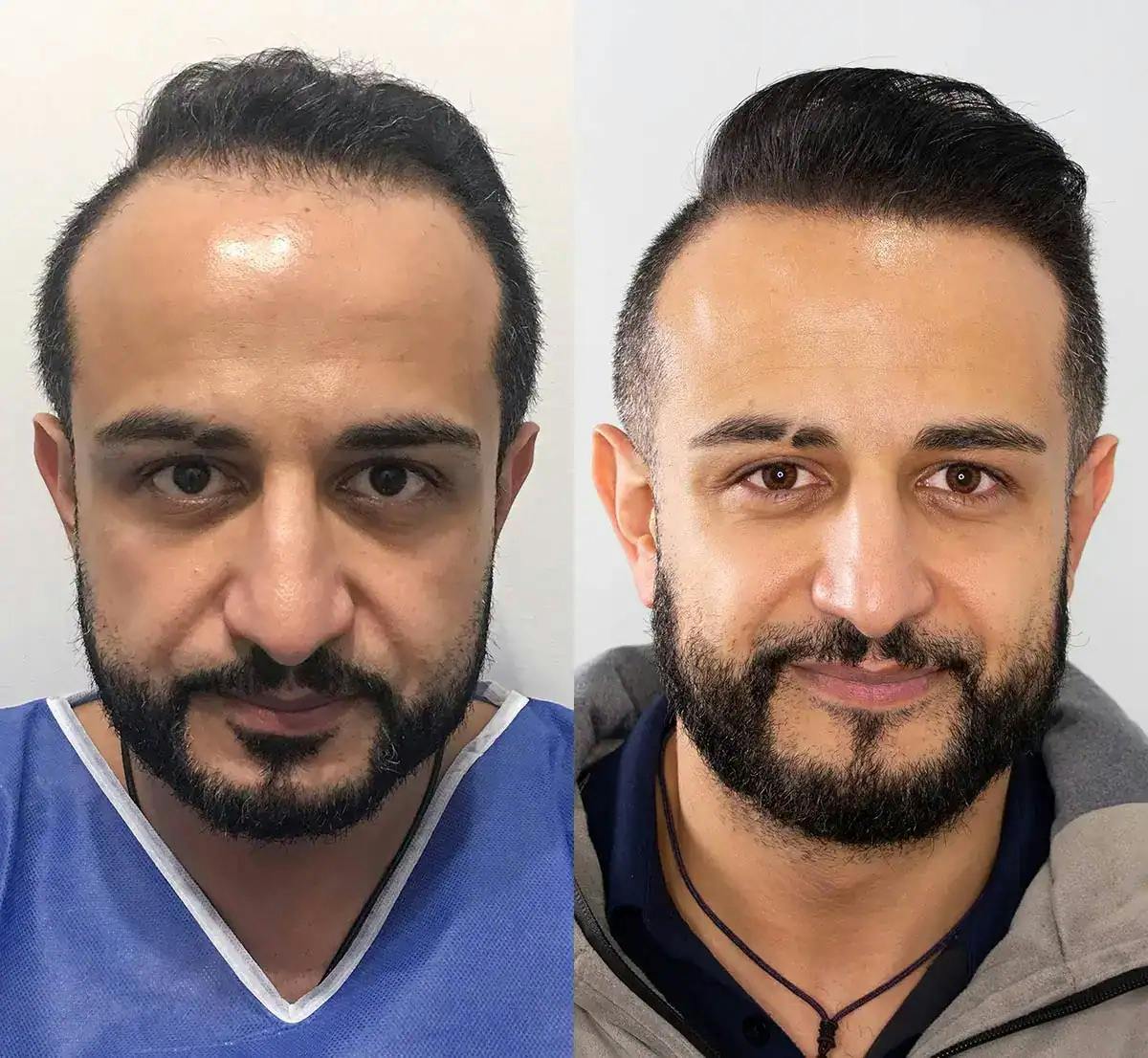 before and after