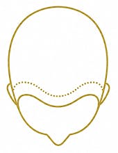 hair transplant graphic