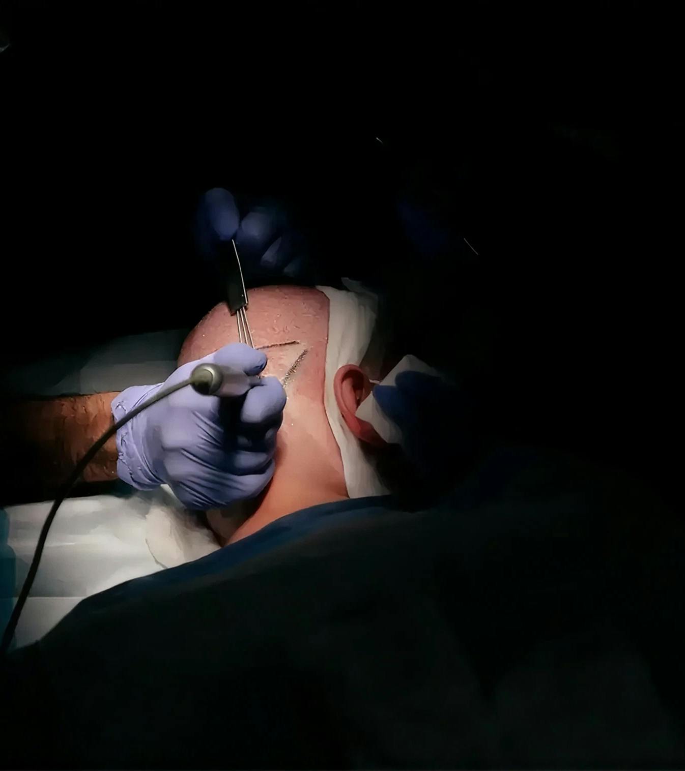 Male receiving FUE hair transplant procedure