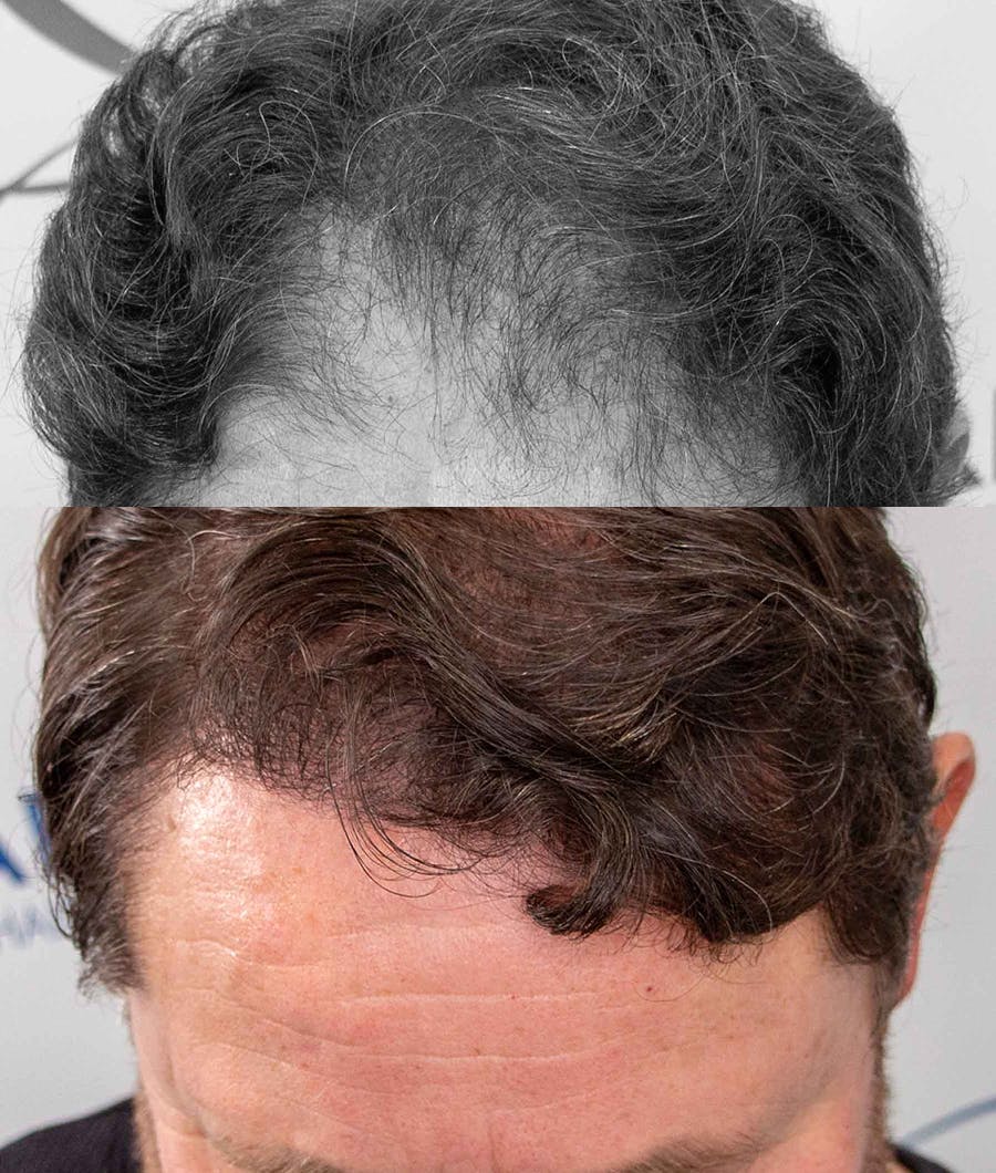 male before and after of FUE hair restoration