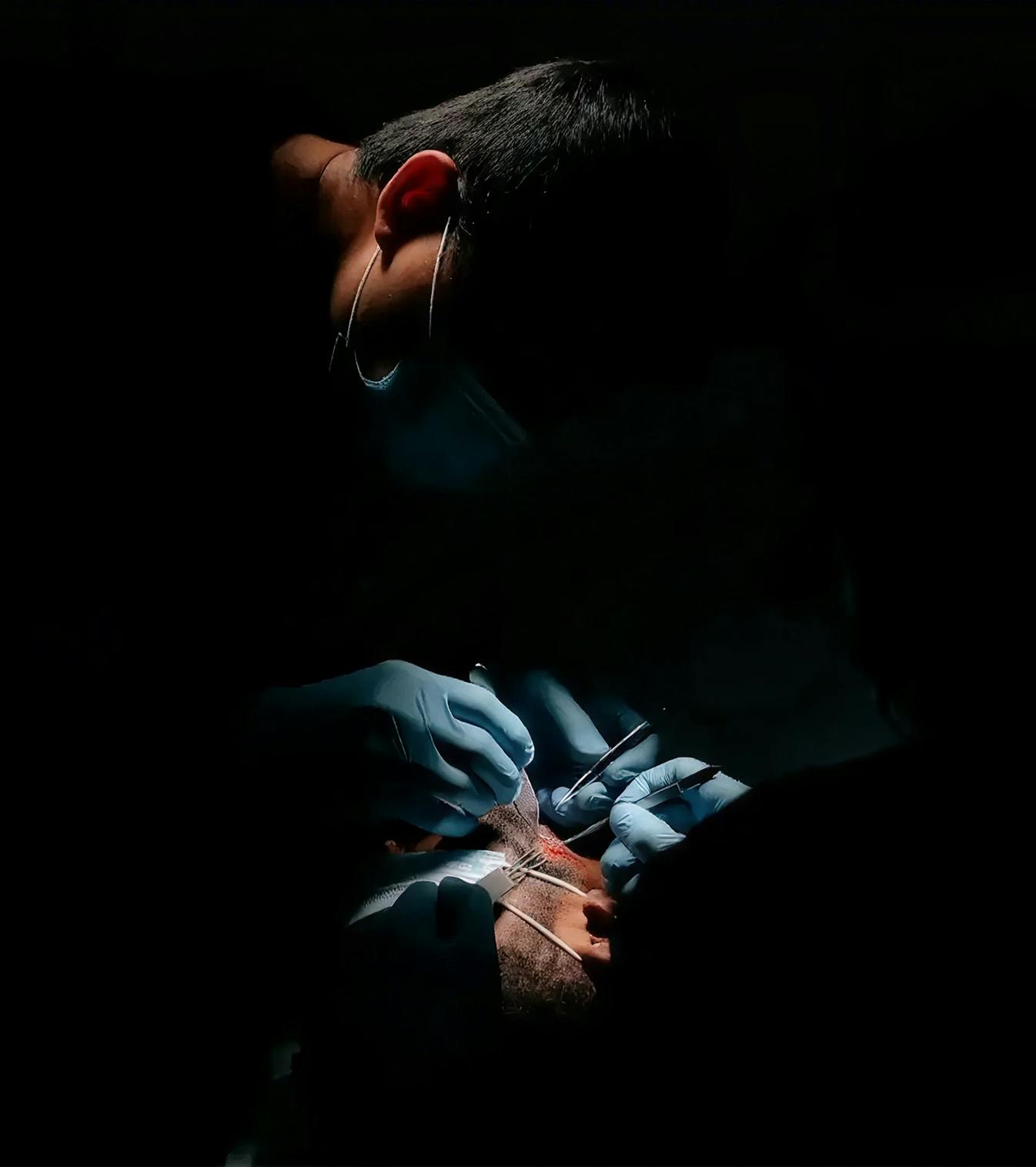 Dr. Sharma performing a beard transplant