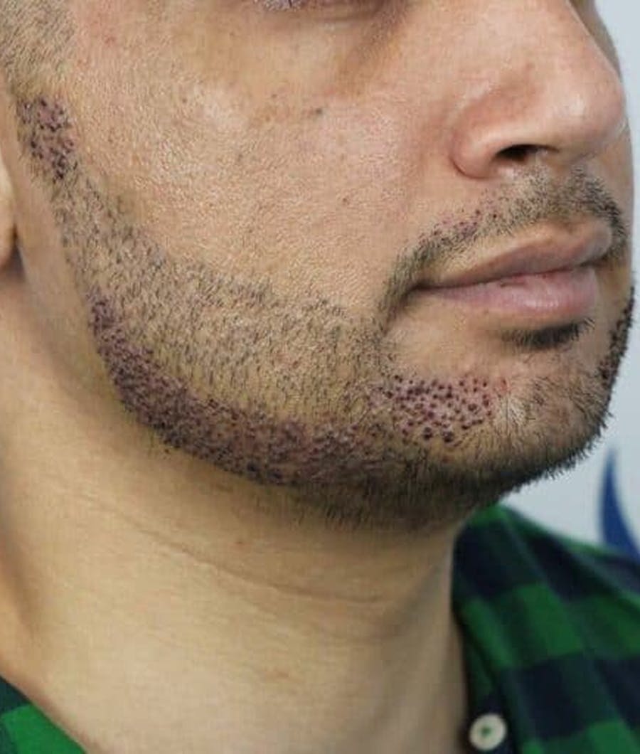beard transplant recovery photo