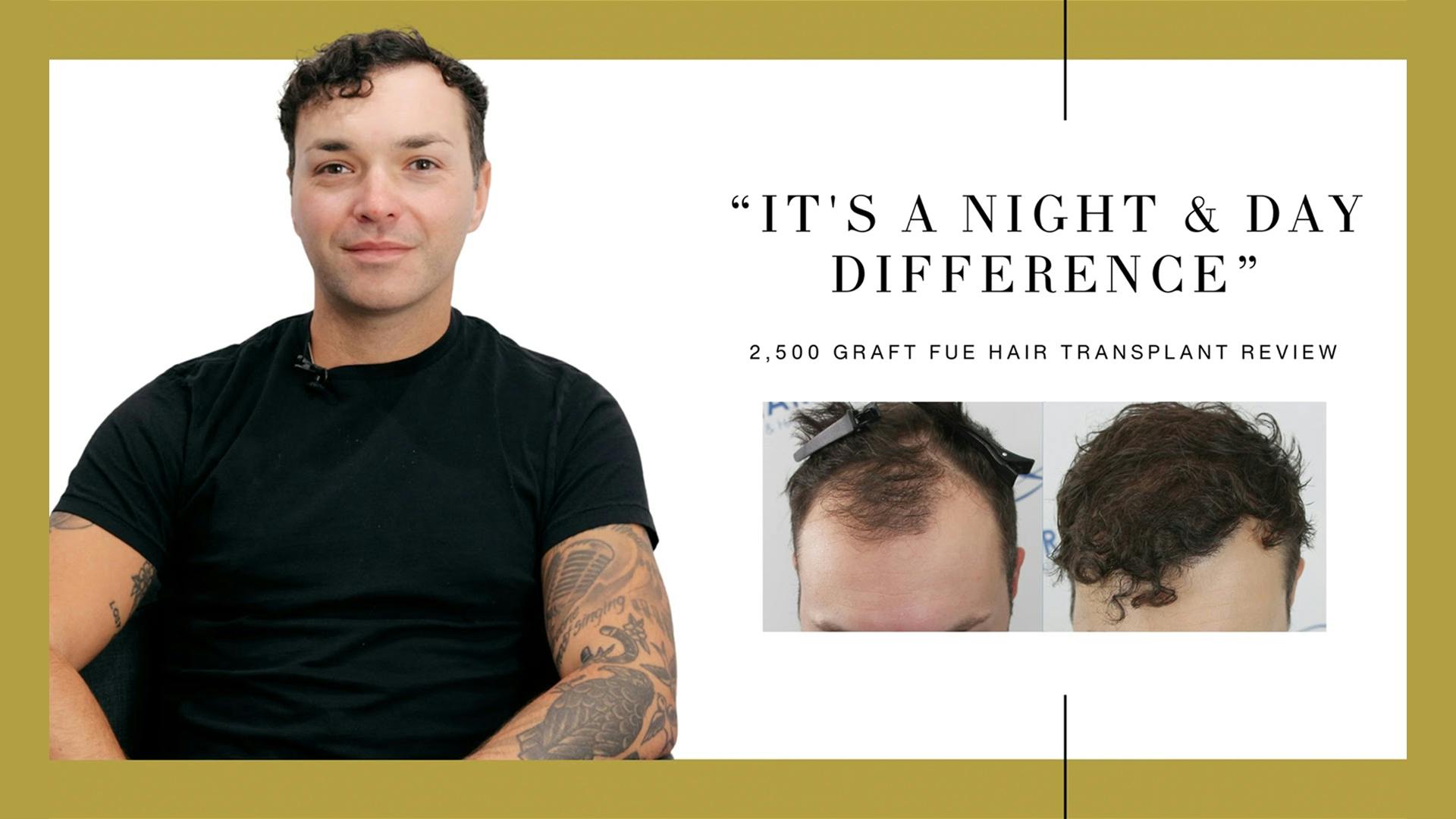 Canadian Hair Transplant Centre
