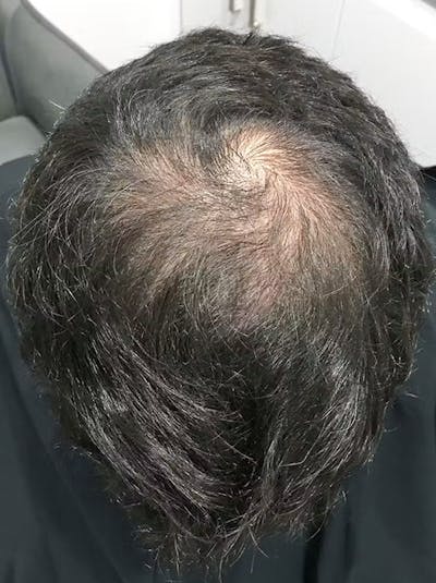 Results Before & After Gallery - Patient 224384 - Image 1