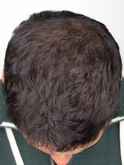 Results Before & After Gallery - Patient 224384 - Image 2