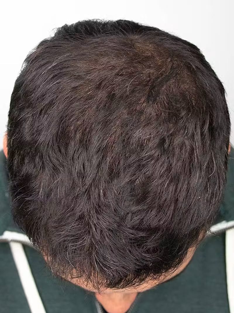 Results Before & After Gallery - Patient 224384 - Image 2