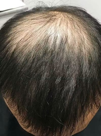 Results Before & After Gallery - Patient 374846 - Image 1