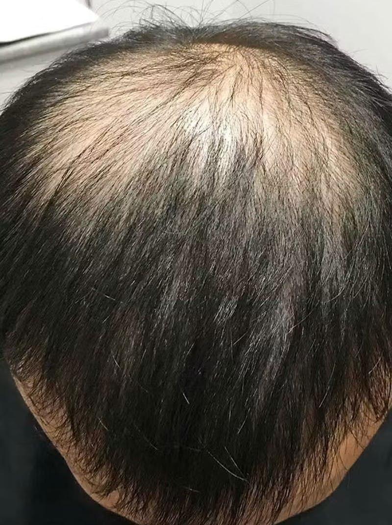 Results Before & After Gallery - Patient 374846 - Image 1