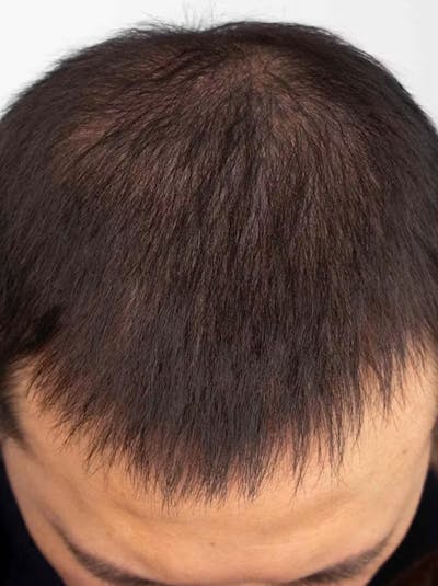 Results Before & After Gallery - Patient 374846 - Image 2
