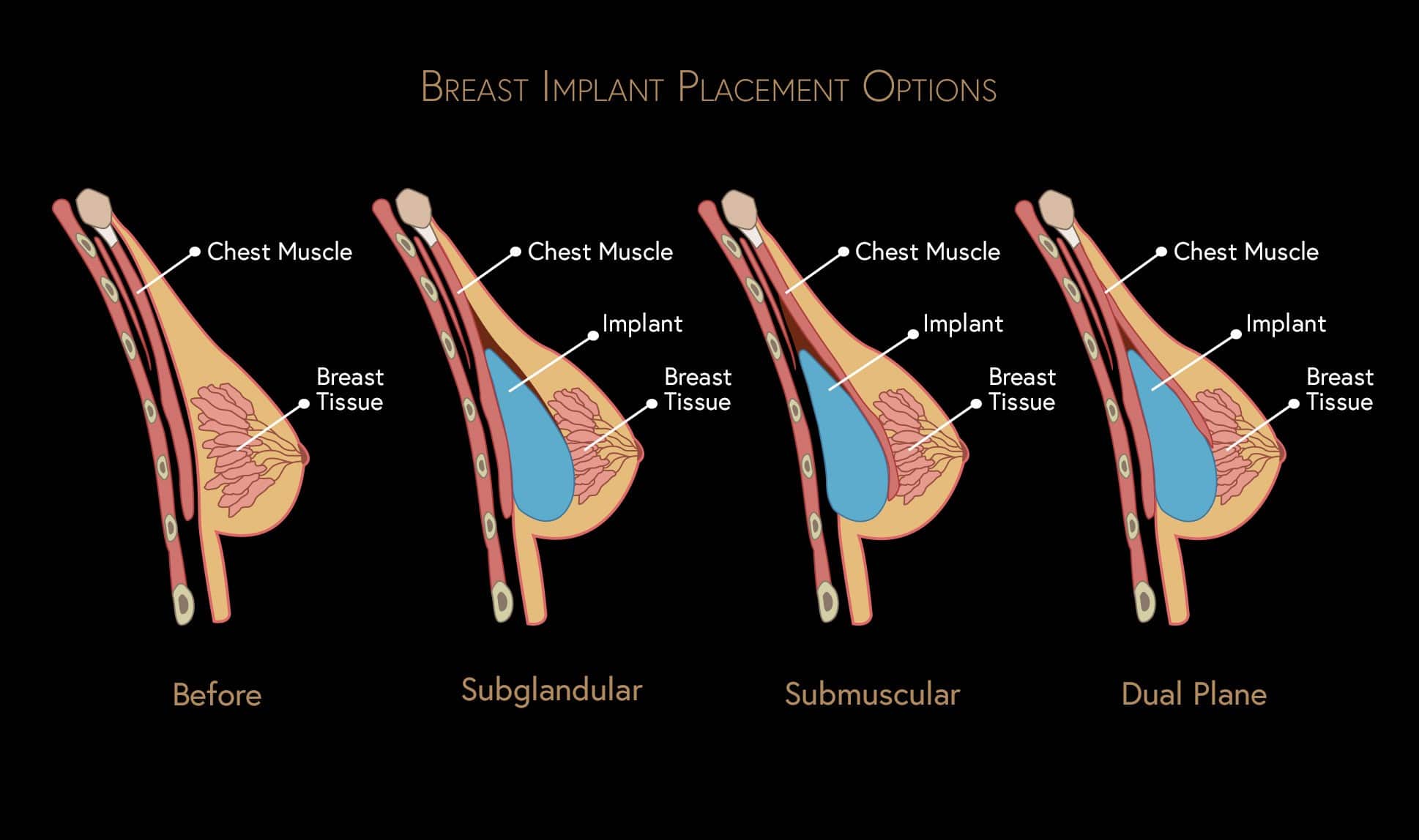 breast augmentation infographic