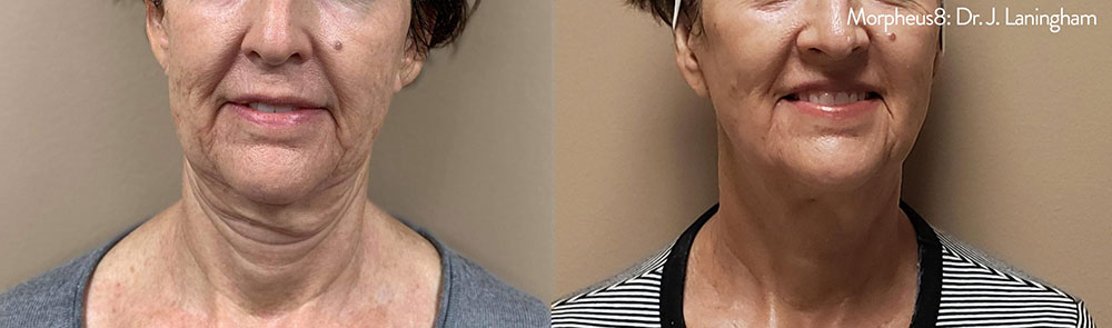 before and after
