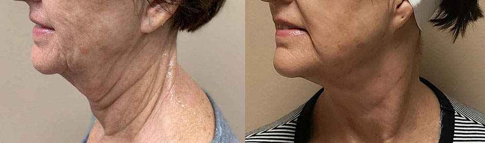 before and after