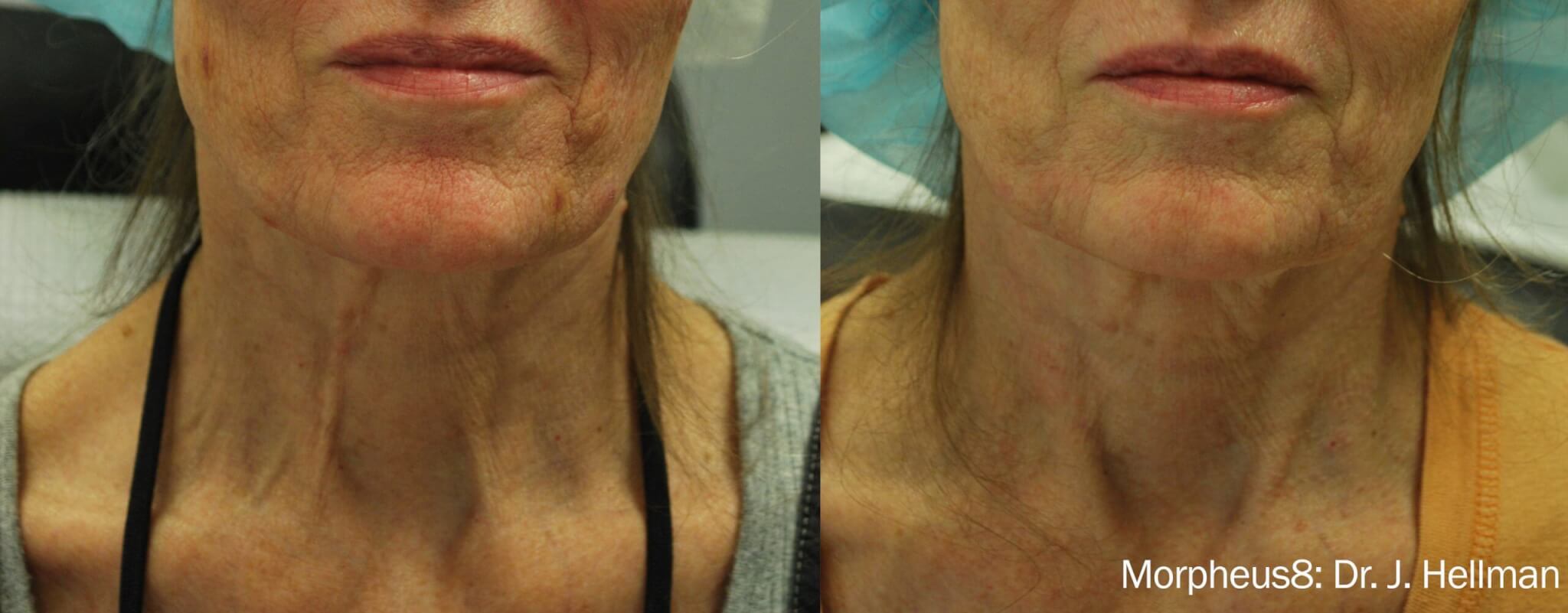 before and after