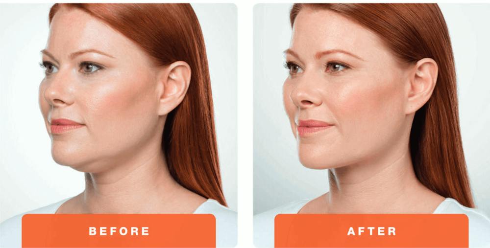 KybellaBeforeAfter