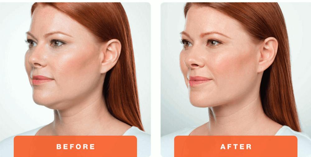 The Facts About KYBELLA™ 1 KybellaBeforeAfter