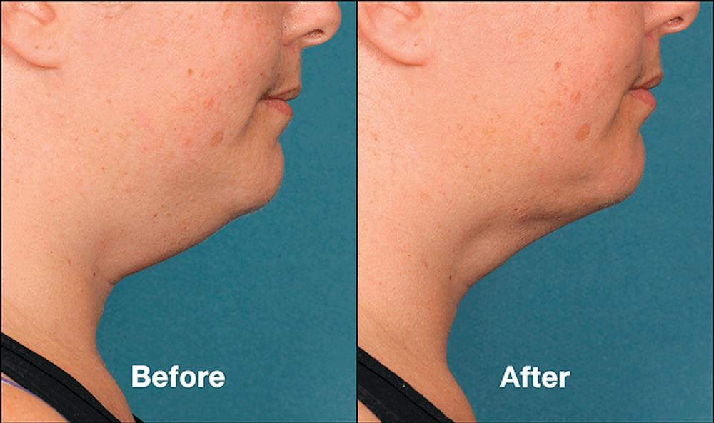KYBELLA FAQ 2 img 1
