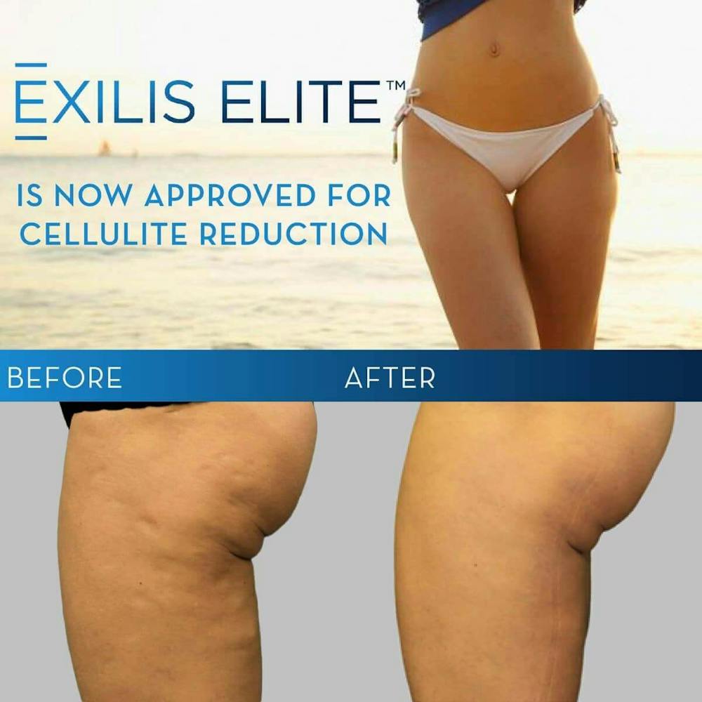 Exilis ELITE Granted FDA Clearance for Treatment to Reduce the Appearance of Cellulite 1 exilis results