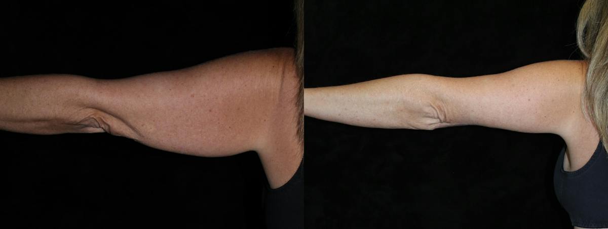 Arm Lift Before & After Gallery - Patient 976862 - Image 1