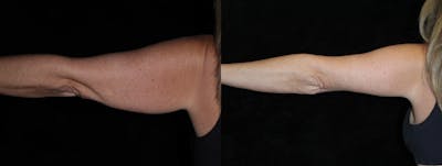 Arm Lift Before & After Gallery - Patient 976862 - Image 1