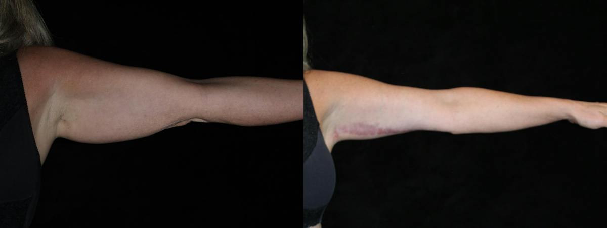 Arm Lift Before & After Gallery - Patient 976862 - Image 3