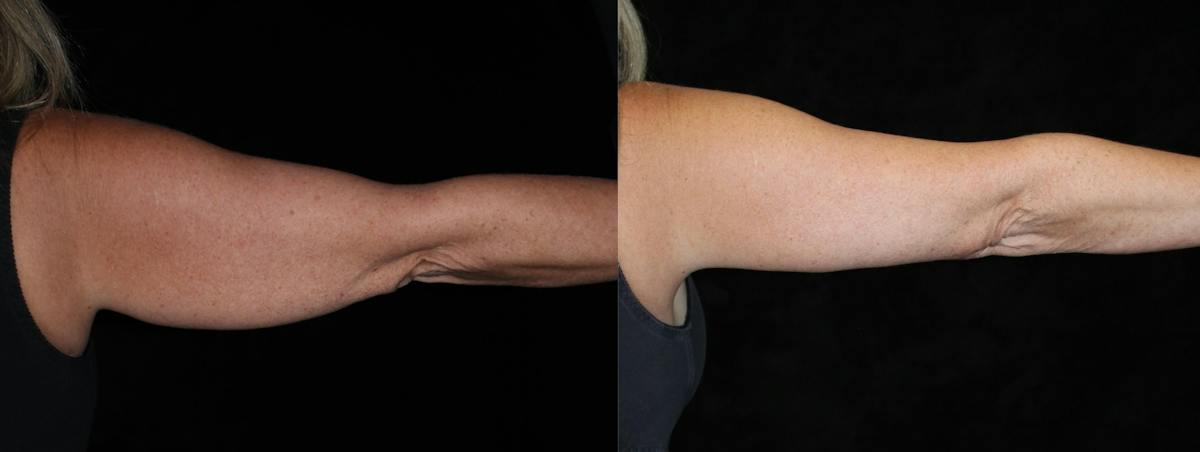 Arm Lift Before & After Gallery - Patient 976862 - Image 2