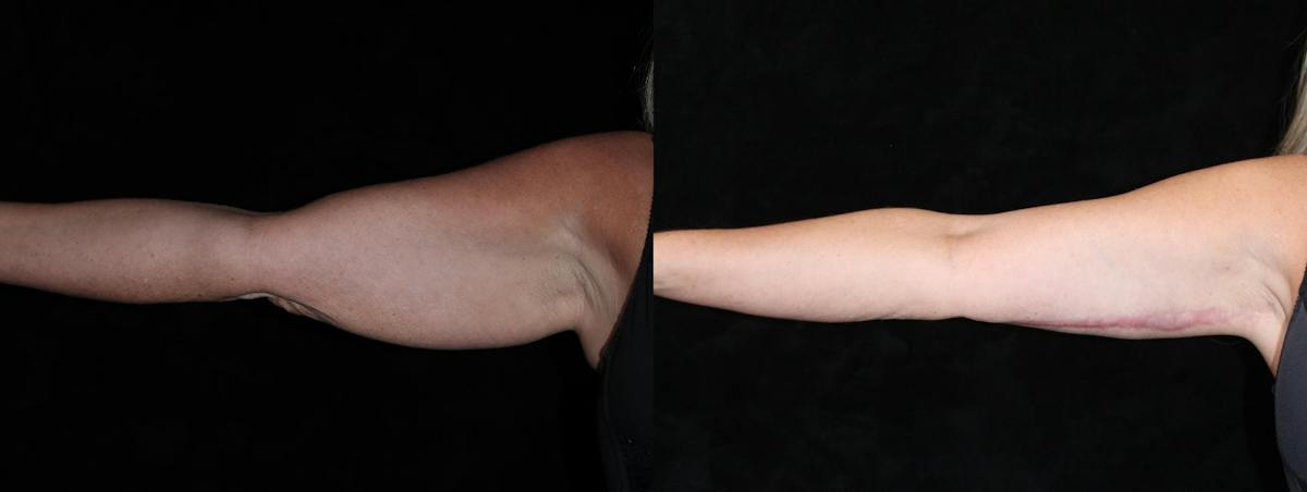 Arm Lift Before & After Gallery - Patient 976862 - Image 4