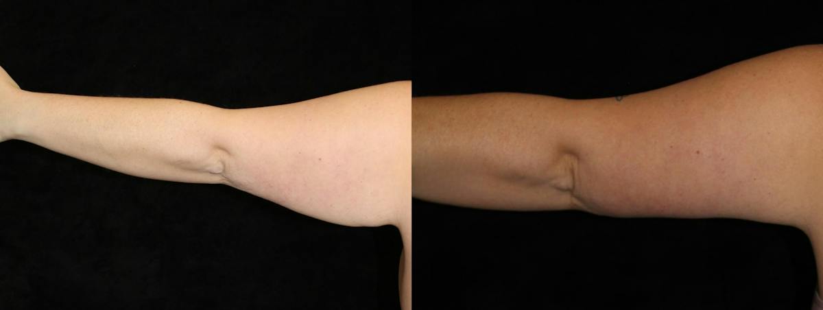 Arm Lift Before & After Gallery - Patient 219685 - Image 3