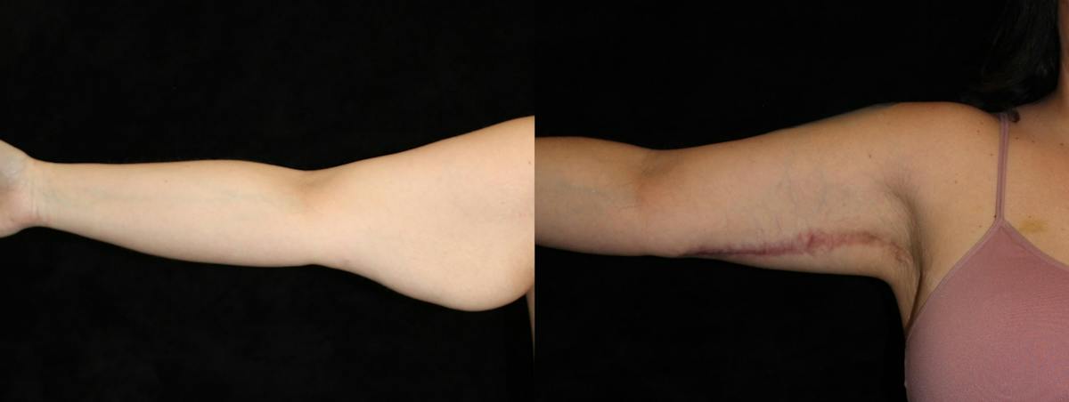 Arm Lift Before & After Gallery - Patient 219685 - Image 1