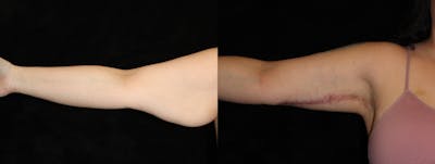 Arm Lift Before & After Gallery - Patient 219685 - Image 1