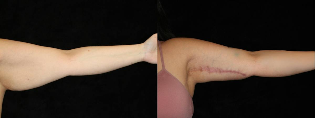 Arm Lift Before & After Gallery - Patient 219685 - Image 2
