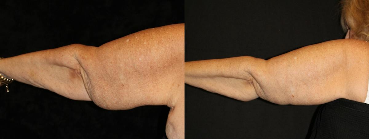 Arm Lift Before & After Gallery - Patient 270441 - Image 3