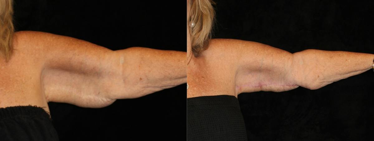 Arm Lift Before & After Gallery - Patient 270441 - Image 2