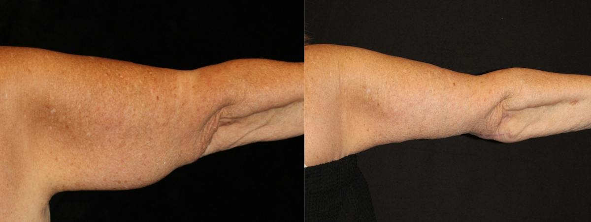 Arm Lift Before & After Gallery - Patient 270441 - Image 4