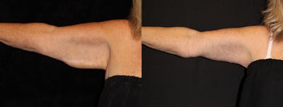 Arm Lift Before & After Gallery - Patient 270441 - Image 1