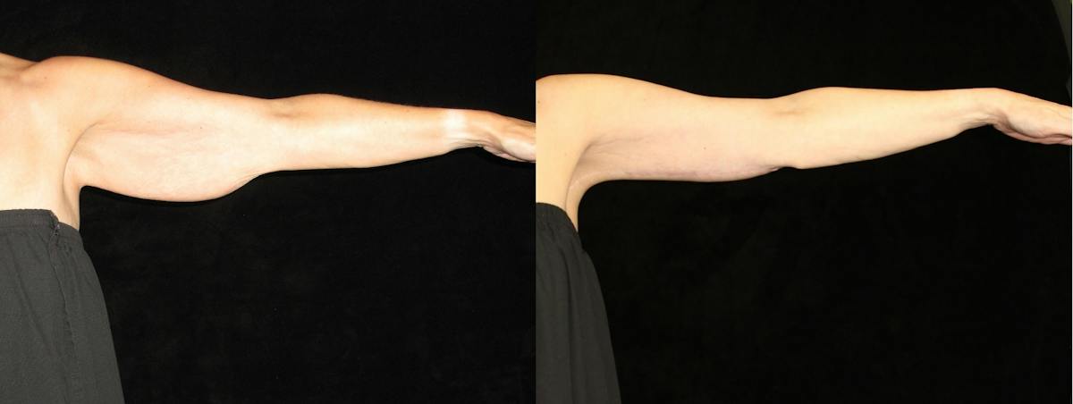 Arm Lift Before & After Gallery - Patient 326537 - Image 2