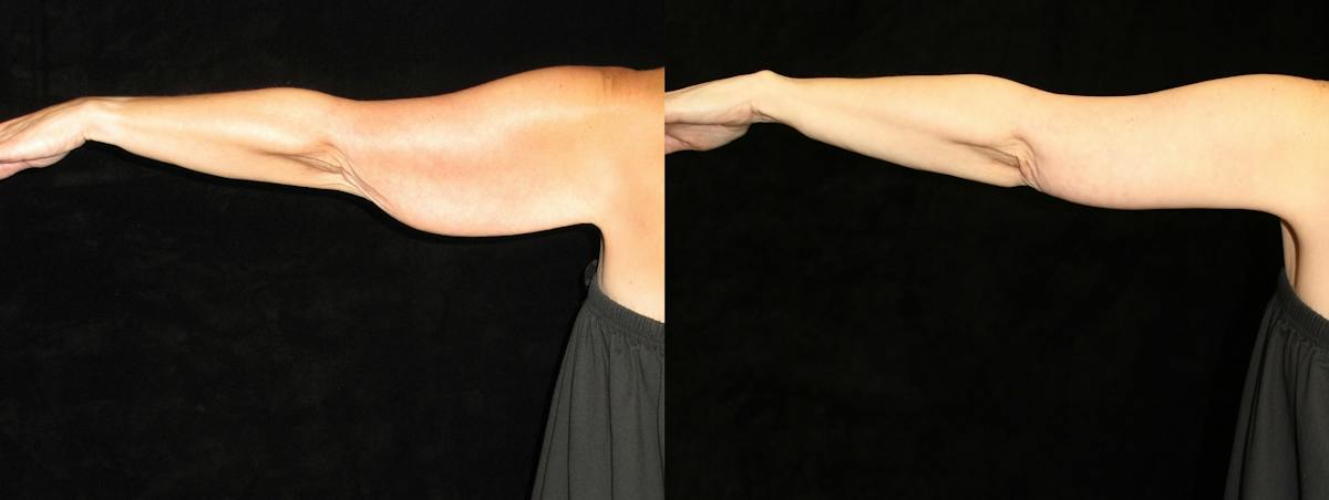 Arm Lift Before & After Gallery - Patient 326537 - Image 3