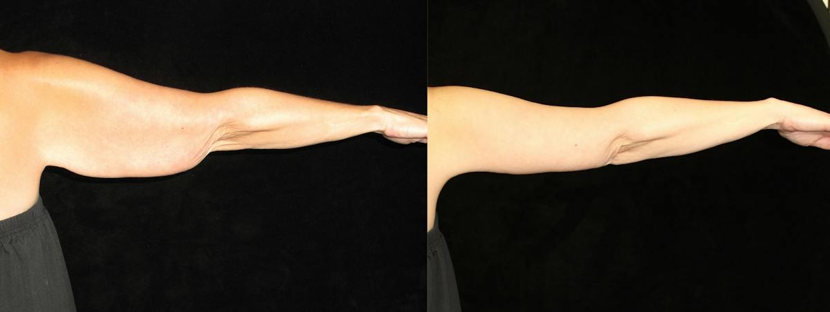 Arm Lift Before & After Gallery - Patient 326537 - Image 4