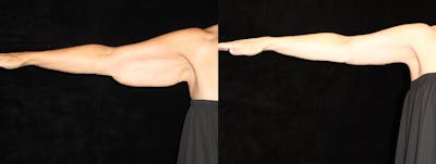 Arm Lift Before & After Gallery - Patient 326537 - Image 1